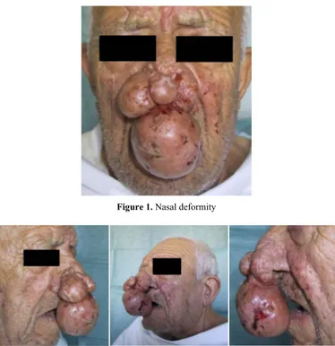 Figure 1. Nasal deformity