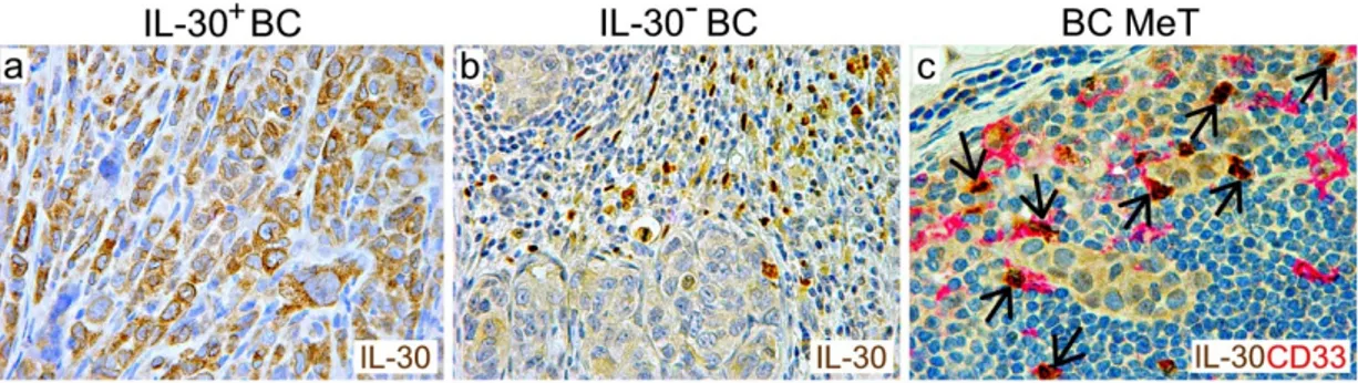 Figure 1. Expression of IL-30 in breast cancer and lymph node metastasis (MeT).  Immunohistochemistry reveals the expression of IL-30 (in brown; ab118910, Abcam) in cancer cells of  a Triple Negative breast cancer (BC) (a), in leukocytes infiltrating an HE