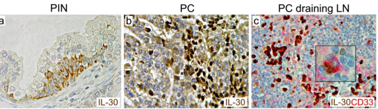 Figure 2. Expression of IL-30 in prostatic intraepithelial neoplasia, high-grade prostate cancer and 