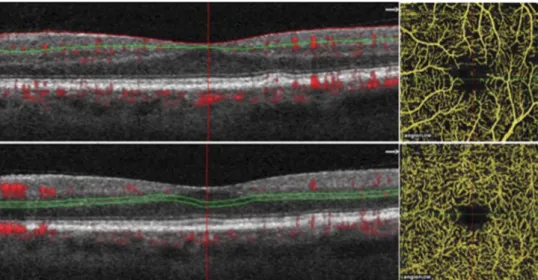 Fig. 1. Representative optical coherence tomography  angiogra-phy macula 3 · 3 scan from an AMD patient