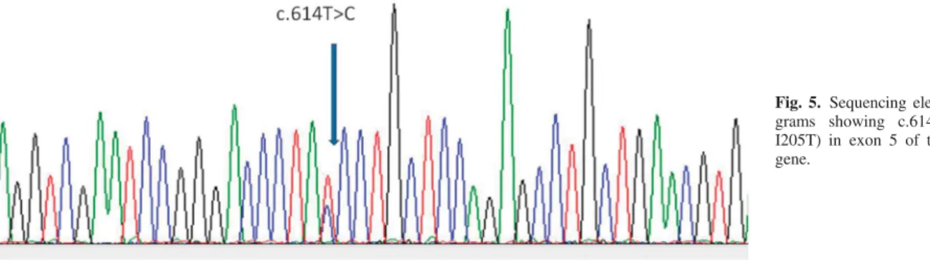 Fig. 5. Sequencing electrophero- electrophero-grams showing c.614T .C (p. I205T) in exon 5 of the BEST1 gene.