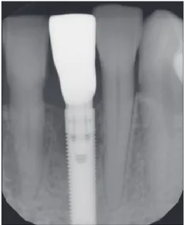 Figure 16: Case 2: radiographic view of ﬁnal restoration.