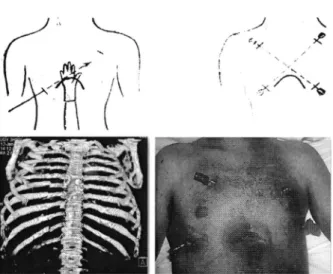 Figure  I.  Surgical  technique  for the  stabilization  ofthe  anterior  flail