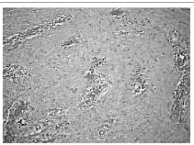 Fig. 5. Scarring collagen deposits, trapping vessels and inflammatory infiltrate are visible.
