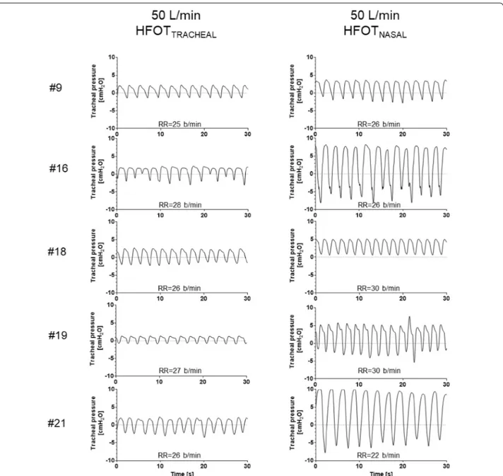 Fig. 3  Thirty-second recordings of tracheal pressure tracings during  HFOT TRACHEAL  and  HFOT NASAL  in 5 patients who underwent tracheostomy  decannulation over the course of ICU stay