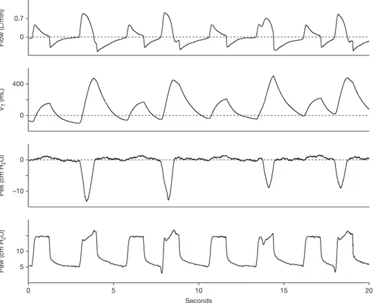 Figure 4. Effects of intermittent spontaneous breathing efforts indicated by negative esophageal pressure swings during a bilevel mode of ventilation