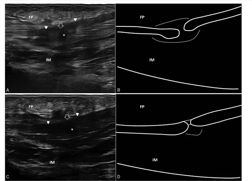 Figure 1. Complete tear. Acute phase. Ultrasound image showing complete tear of the mid-portion of the plantar fascia (white void arrow), with retraction of the 2 stumps (white arrowheads) and local effusion (asterisk) (A)