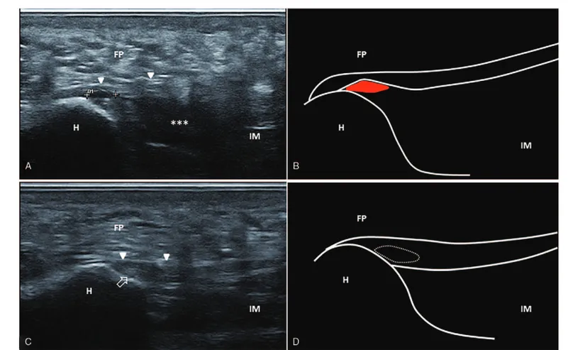 Figure 2. Partial tear. Acute phase. Ultrasound image showing partial tear of the plantar fascia (double cross) at the level of the insertional region over the calcaneal tuberosity, with post-traumatic edema of the intrinsic muscles of the foot (asterisks)