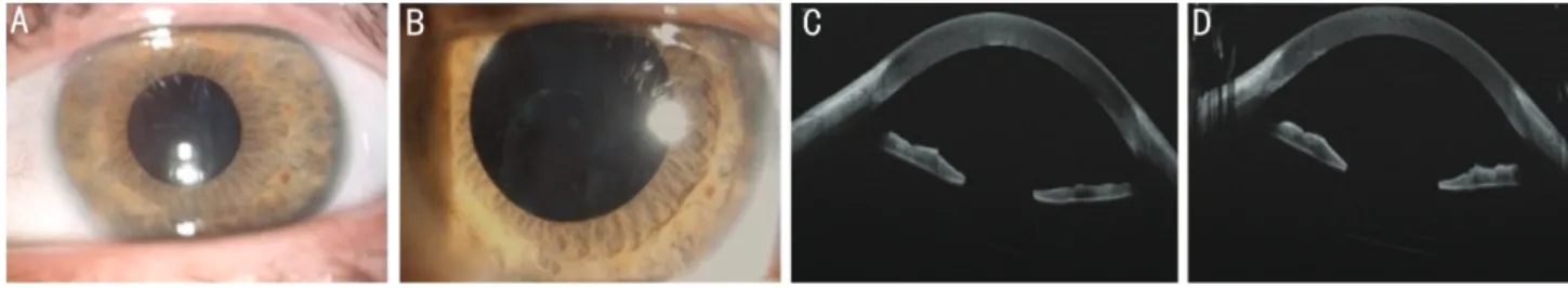Figure 3 After multimodal therapeutic approach  Slit lamp segment anterior photography of the left eye after capsulotomy femtosecond laser 