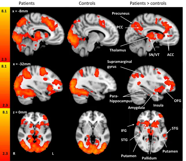 Fig 2. Maps illustrating activation of brain regions during the PIT task activity. Statistical maps of the patient group, the control group and