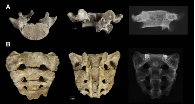 Fig. 5. (A) Fifth lumbar vertebra, showing failure of osseous fusion of the neural arch, leaving a bony cleft