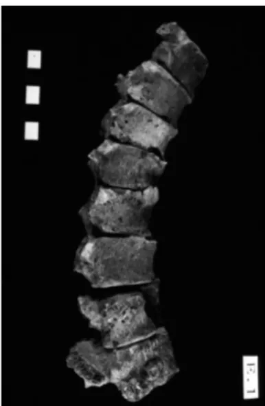 Fig. 7 - Lesioni tipiche da tuberco- tuberco-losi alla colonna vertebrale.