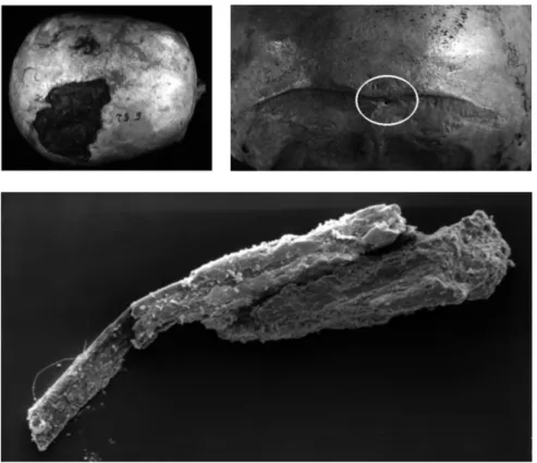 Fig. 10 - La vasta incrostazione a destra del vertex è il risultato dell’ossidazione di un  fermaglio; i sali derivati hanno impregnato i capelli circostanti ed il sottostante cuoio  capelluto preservandoli fino ad oggi con un vero e proprio processo di fo