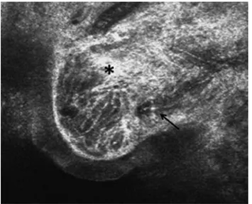 Figure 3. Epithelial microcysts in patient treated with PF. PGAs appear as  dark,  round  or  oval-shaped  structures  (asterisk),  sometimes clustered, below the conjunctival epithelium.