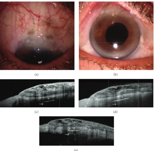 Figure 1: Spectral domain- (SD-) and time domain- (TD-) OCT assessment of a cystic filtering bleb