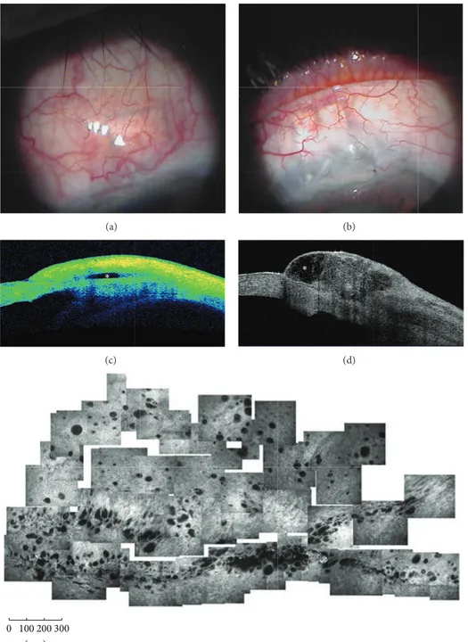 Figure 2: Functioning filtering blebs. Functioning blebs, after MMC-augmented trabeculectomy, present a diffuse (a) or a cystic shape (b) at clinical evaluation