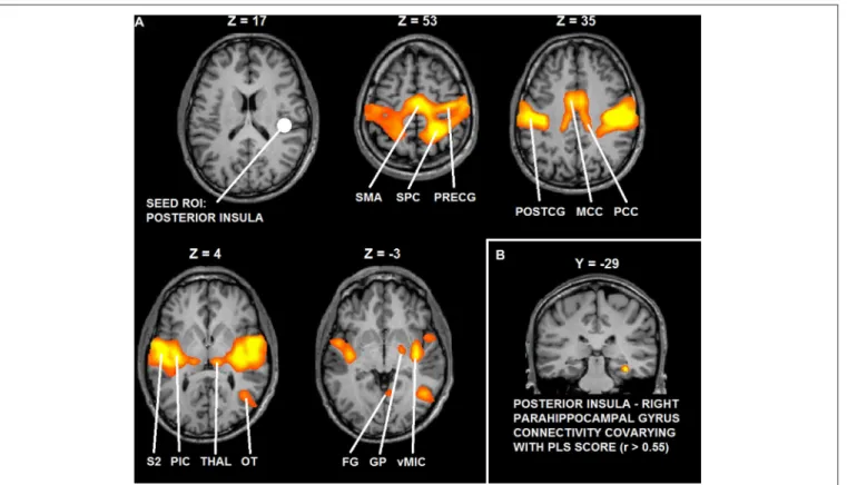 FIGURE 6 | (A) Functional connectivity maps of the seed ROI in right posterior insula