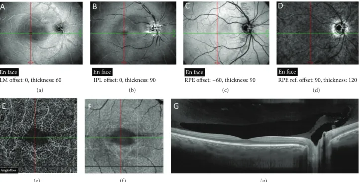 Figure 1: OCT images of normal eye. (a)–(d) En face OCT images at different segmentation thicknesses