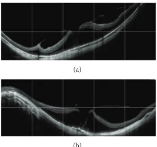 Figure 2: OCT images of myopic eye. Myopic foveoschisis associ- associ-ated with tangential traction due to ERM and vitreoschisis.