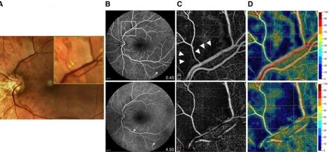 Fig. 1 Multimodal retinal imaging of 25-year-old woman affected by Susac’s syndrome and showing multiple branch retinal artery occlusions (BRAOs)