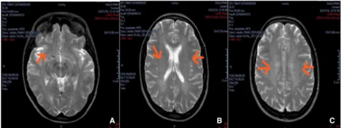 Fig. 4 FLAIR-coronal sequences showing a small hyperintense acute inflammatory lesion in corpus callosum (right part) (a), and some small spots located in basal ganglia (b)