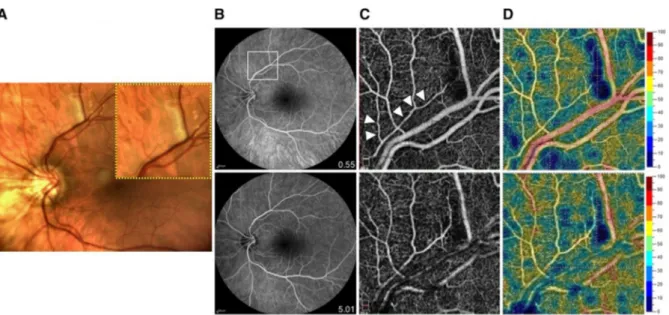 Fig. 5 Follow-up visit features on multimodal imaging of retinal healing after immunosuppressive therapy