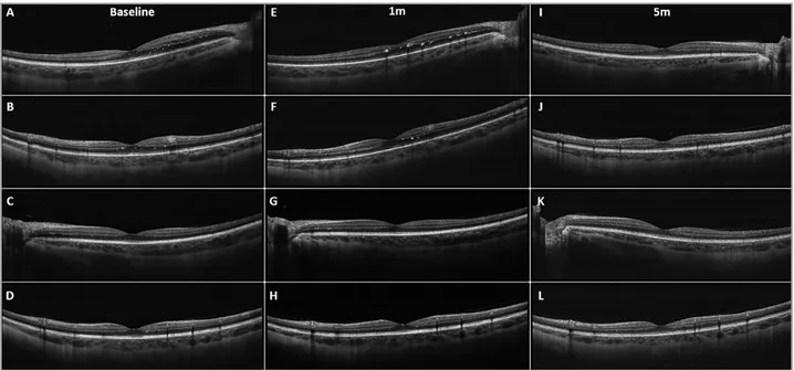 Figure 1. Spectral-domain optical coherence tomography (SD-OCT) scans performed at baseline, at the 1-month visit (1m), and at the  5-month visit (5m)