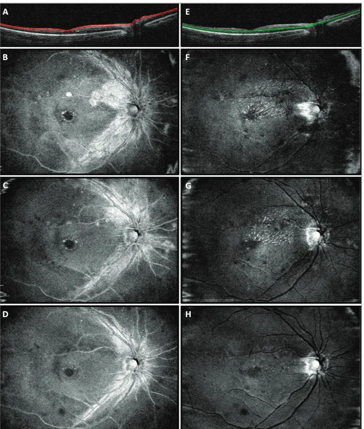 Figure 2. En face optical coherence tomography (OCT) scans from the right eye of the case report patient