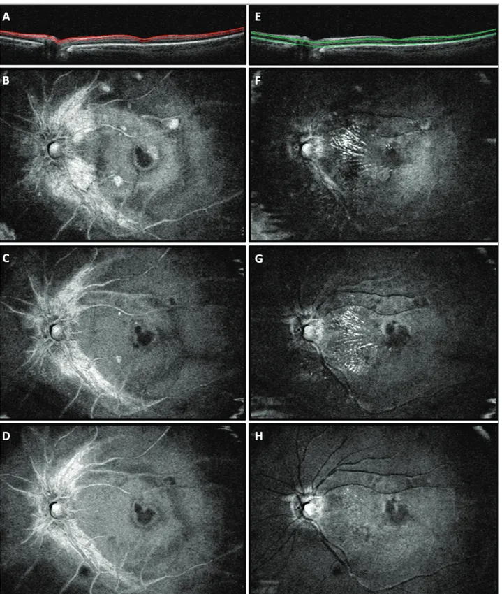 Figure 3. En face optical coherence tomography (OCT) scans from the left eye of the case report patient