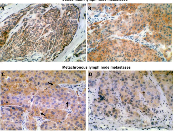 Figure 1: HER-3 expression in human metastatic melanoma.   (A) (160X original magnification) and (B) (250X original  magnification): concomitant lymph node metastases