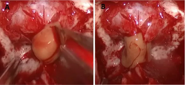 Figure 2. Intraoperative picture before (A) and after (B) sellar dura incision, showing a mucinous yellowish fluid flow- flow-ing from the cyst.