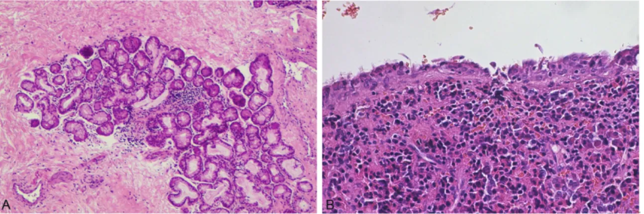 Figure 3. Microscopic features. A: Salivary tissue contained in the cyst wall (HE, x100)