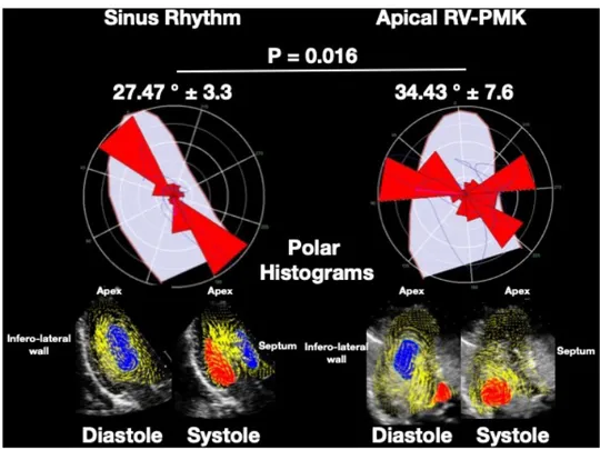 Figure 4  Histograms of KE variations during sinus rhythm  and RVA-pacing. KE, kinetic energy; PMK, pacemaker; RV,  right ventricle.