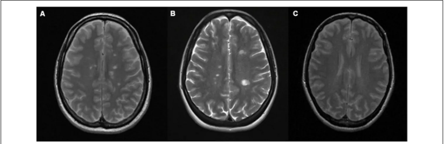 FIGURE 1 | Conventional magnetic resonance imaging (MRI) showing similar demyelinating lesions in: (A) multiple sclerosis (MS) and (B) antiphospholipid syndrome (APS)