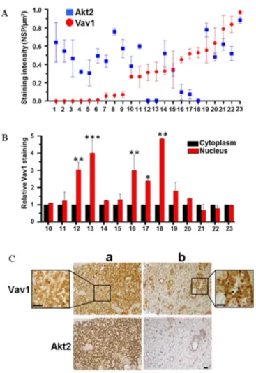 Figure 4. Expression and subcellular localization of Vav1 in pancreatic adenocarcinoma tissues