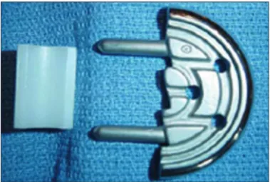 Fig. 1.  The McKeever interpositional hemiarthroplasty device, consi- consi-sting of vitallium component to replace the medial tibial plateau.