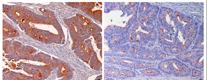 Fig. 3  Examples of LGALS3BP staining in CRC. Immunohistochemical staining showing high (left) and low (right) expression of LGALS3BP in a case 