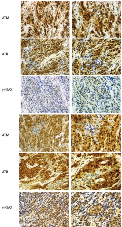 Figure 1.   Representative examples of two breast cancer cases with pATR, pATM and γ-H2AX nuclear  immunohistochemical expression.