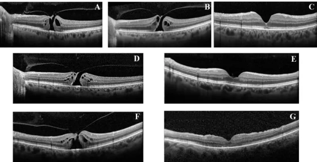 Figure 1. A, baseline optical coherence tomography scan of a patient in the OCRIVIT group who 