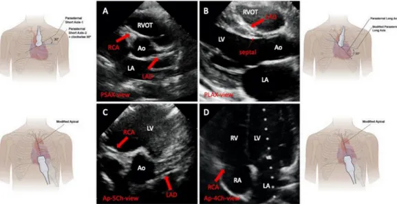 Figure 3  Two- dimensional echocardiographic 4- view approach for AAOCA detection: abnormal examinations and their  anatomic correlates