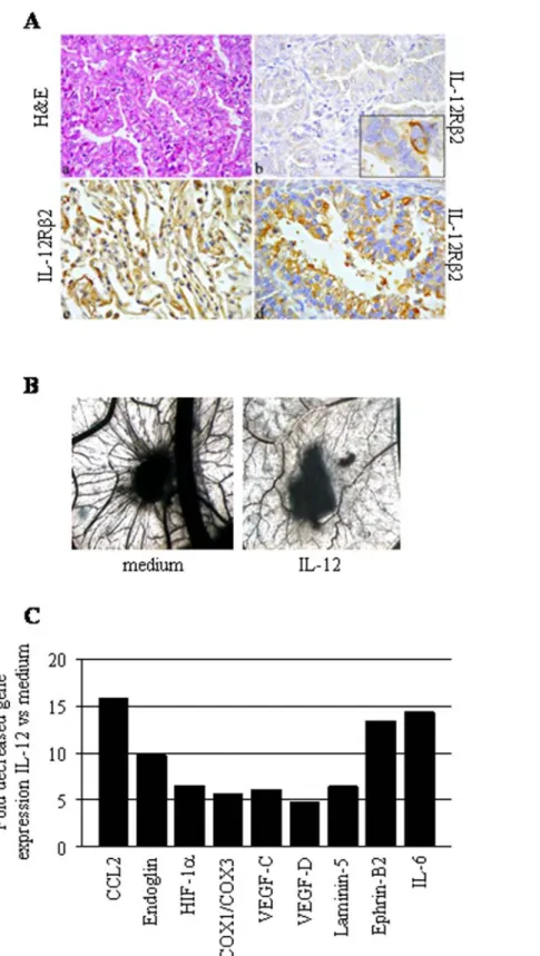 Figure 1. IL-12Rb2 expression and function in human lung adenocarcinoma. 1A. Histological features and IL-12Rb2 expression in human bronchioloalveolar lung carcinomas