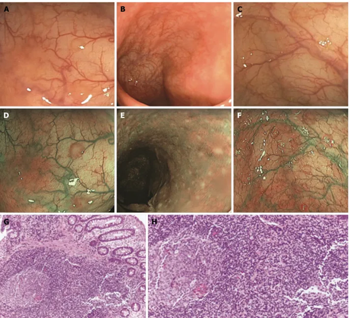 Figure 2  Endoscopic and histological features of nodular lymphoid hyperplasia. A-F: Three typical cases of nodular lymphoid hyperplasia (NLH), as observed 