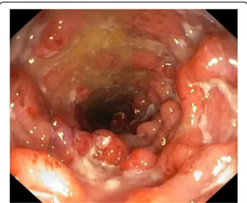 Fig. 1 Endoscopic aspects of the transverse colon before colectomy. There are diffuse mucosal ulcerations and nodules/pseudopolyps