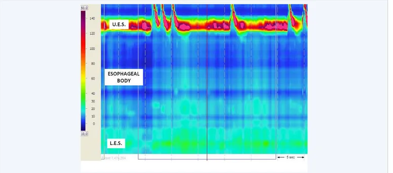 Figure  1   HRM  tracing  at  the  beginning  of  recording.  From  top  to  bottom  Upper  Esophageal  Sphincter  (U.E.S.),  Esophageal  Body  and  Lower  Esophageal Sphincter (L.E.S.) reveal that after swallow, no peristaltic activity was present through