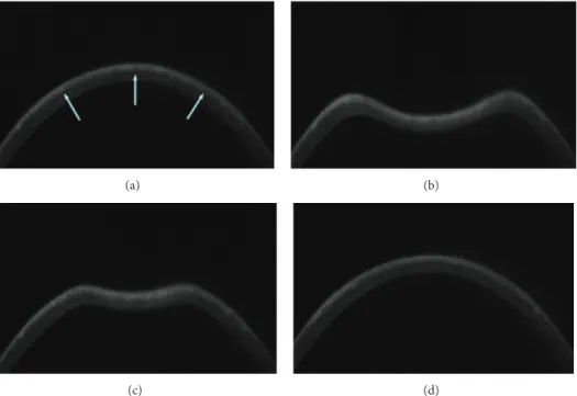Figure 1: Corvis UHS Scheimpflug camera frames of corneal response to a metered, collimated air pulse: air pulse forces cornea that underwent SMILE procedure (a) inwards through applanation into a concavity phase until it achieves the highest concavity (b)