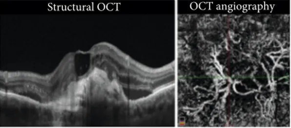 Figure 4: CNV associated with atrophy. Structural OCT shows minimal exudation as intraretinal cystic spaces and subretinal ﬂuid above and hyperreﬂective material below the RPE (yellow asterisks)
