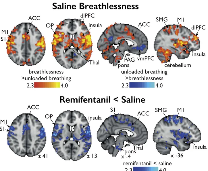 Fig. 5. BOLD activity during the breathlessness condition during saline (placebo) infusion (top ﬁgure) and the eﬀect of remifentanil infusion (lower ﬁgure)