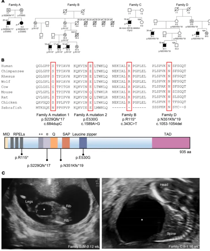 Figure 1. Identification of MYOCD variants in 4 families with congenital megabladder. (A) Pedigrees of 4 families presenting with congenital megablad-
