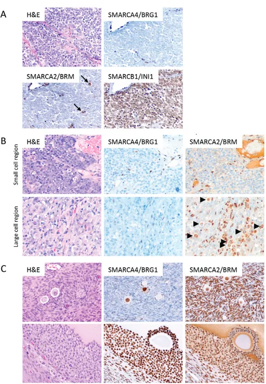Figure 1. Immunohistochemical analysis of core SWI/SNF proteins in SCCOHT. (A) Dual loss of SMARCA4/BRG1 and SMARCA2/BRM in