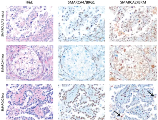 Figure 2. Immunohistochemical analysis of SMARCA4/BRG1 and SMARCA2/BRM in ovarian clear cell carcinoma